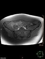 Cesarian scar endometriosis (Radiopaedia 68495-78066 Axial T1 fat sat 3).jpg