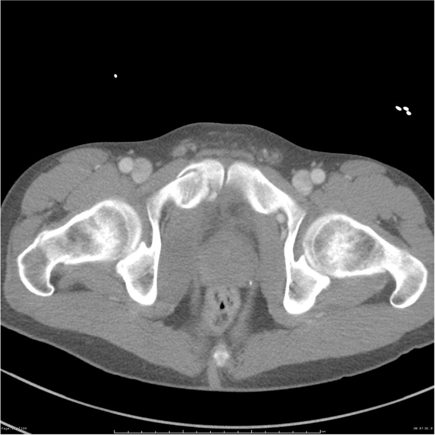 Chest and abdomen multi-trauma (Radiopaedia 26294-26426 A 87).jpg