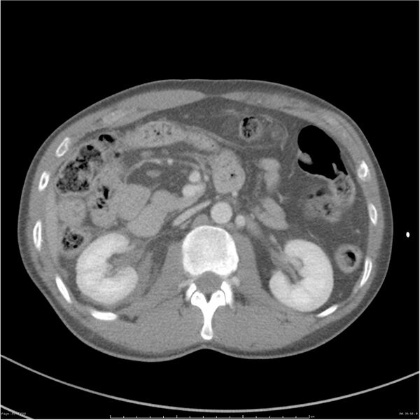 File:Chest and abdomen multi-trauma (Radiopaedia 26294-26426 bone window 35).jpg
