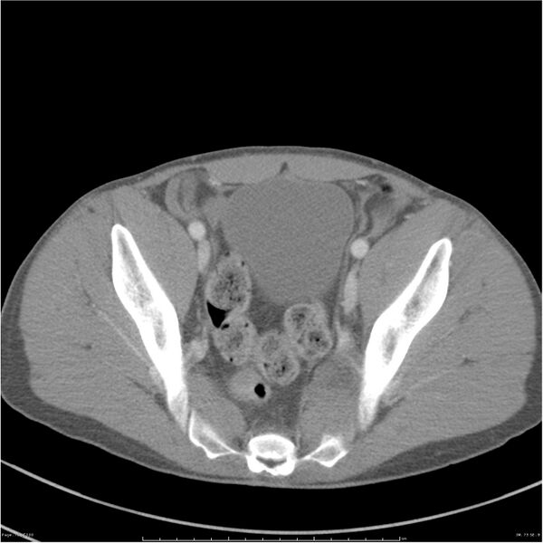 File:Chest and abdomen multi-trauma (Radiopaedia 26294-26426 bone window 73).jpg