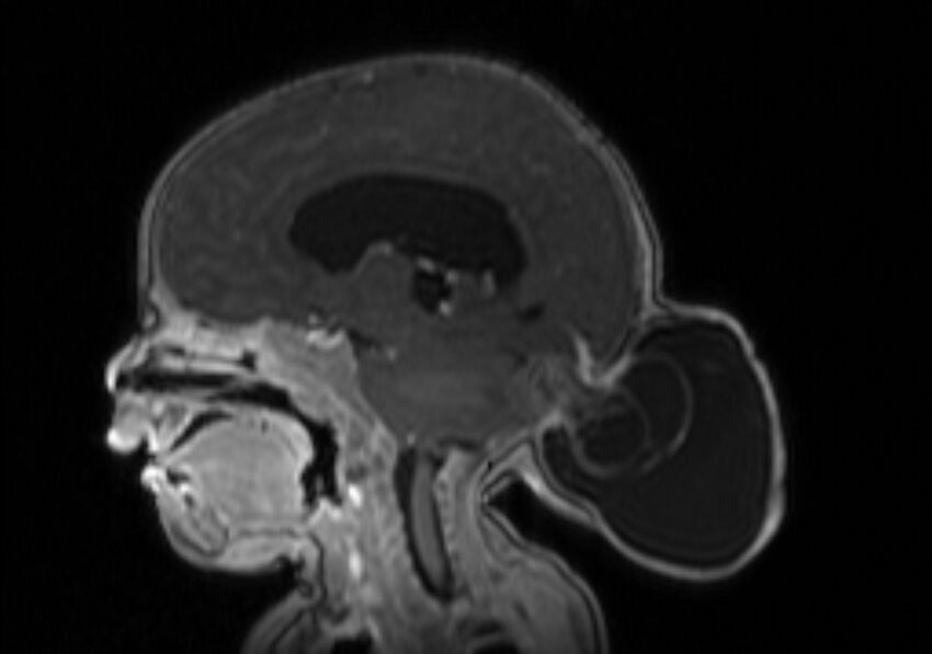 Chiari III malformation with occipital encephalocele (Radiopaedia 79446-92559 Sagittal T1 C+ mpr 34).jpg