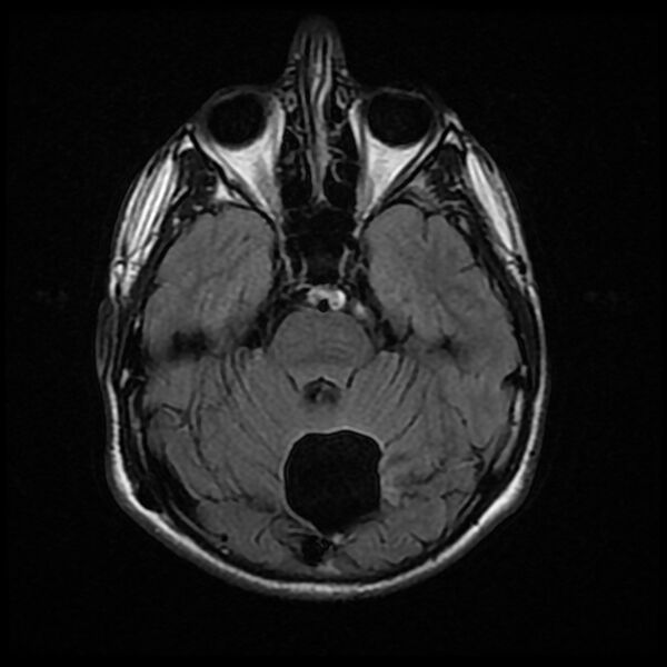File:Chiasmatic-hypothalamic juvenile pilocytic astrocytoma (Radiopaedia 78533-91235 Axial FLAIR 10).jpg