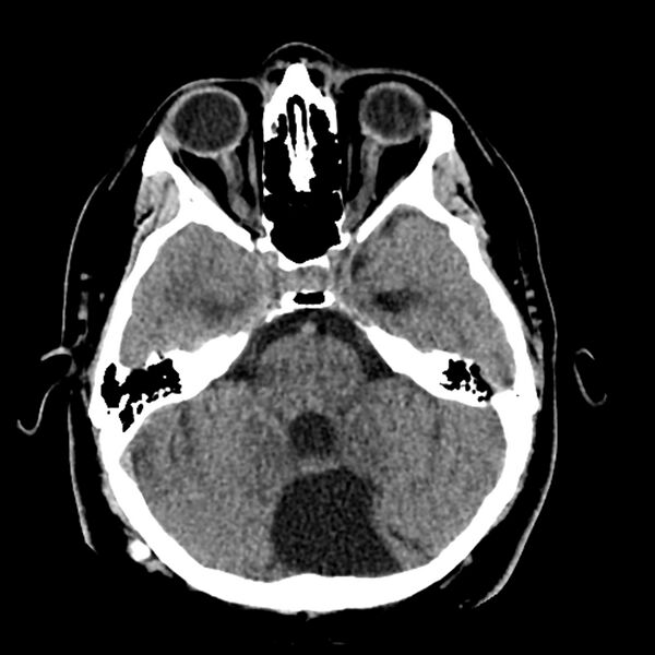 File:Chiasmatic-hypothalamic juvenile pilocytic astrocytoma (Radiopaedia 78533-91237 Axial non-contrast 19).jpg