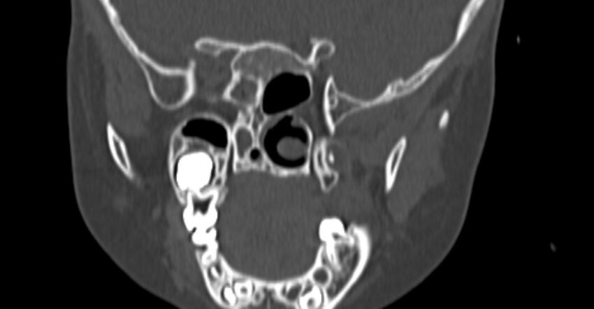 Choanal atresia (Radiopaedia 51295-56972 Coronal bone window 67).jpg