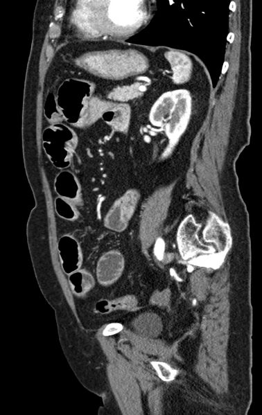File:Cholecystoduodenal fistula due to calculous cholecystitis with gallstone migration (Radiopaedia 86875-103077 C 22).jpg
