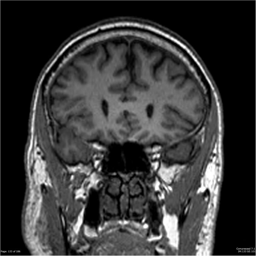 Chondrosarcoma of skull base- grade II (Radiopaedia 40948-43654 Coronal T1 54).jpg