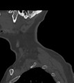 Chordoma (C4 vertebra) (Radiopaedia 47561-52188 Sagittal bone window 5).png