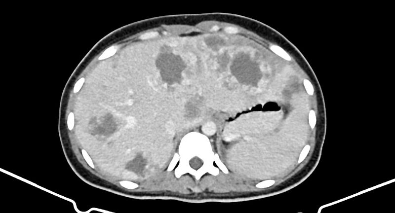 File:Choriocarcinoma liver metastases (Radiopaedia 74768-85766 A 52).jpg