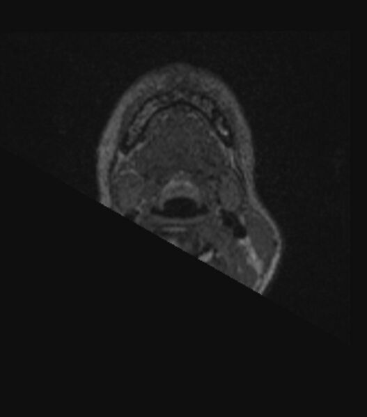 File:Choroid plexus carcinoma (Radiopaedia 91013-108553 Axial FLAIR C+ 17).jpg