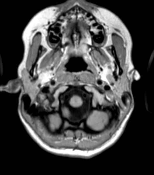 File:Choroid plexus carcinoma (Radiopaedia 91013-108553 Axial T1 30).jpg
