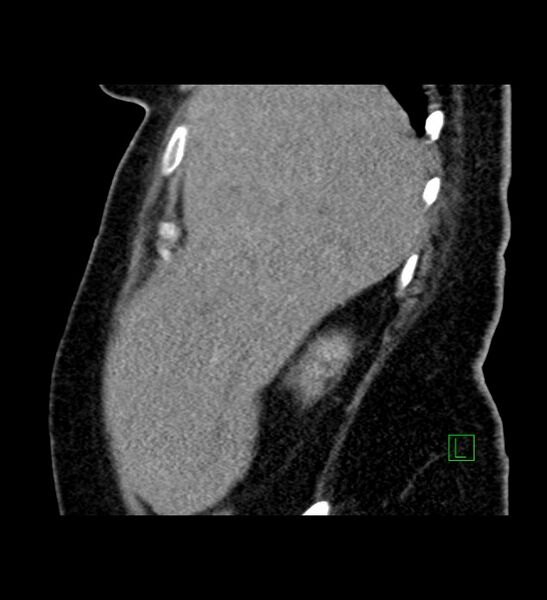 File:Chromophobe renal cell carcinoma (Radiopaedia 84239-99519 D 96).jpg
