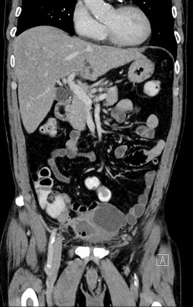 File:Chronic appendicitis complicated by appendicular abscess, pylephlebitis and liver abscess (Radiopaedia 54483-60700 C 31).jpg