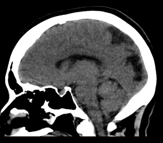 File:Chronic bilateral occipital lobe infarcts (Radiopaedia 31276-31996 C 22).jpg