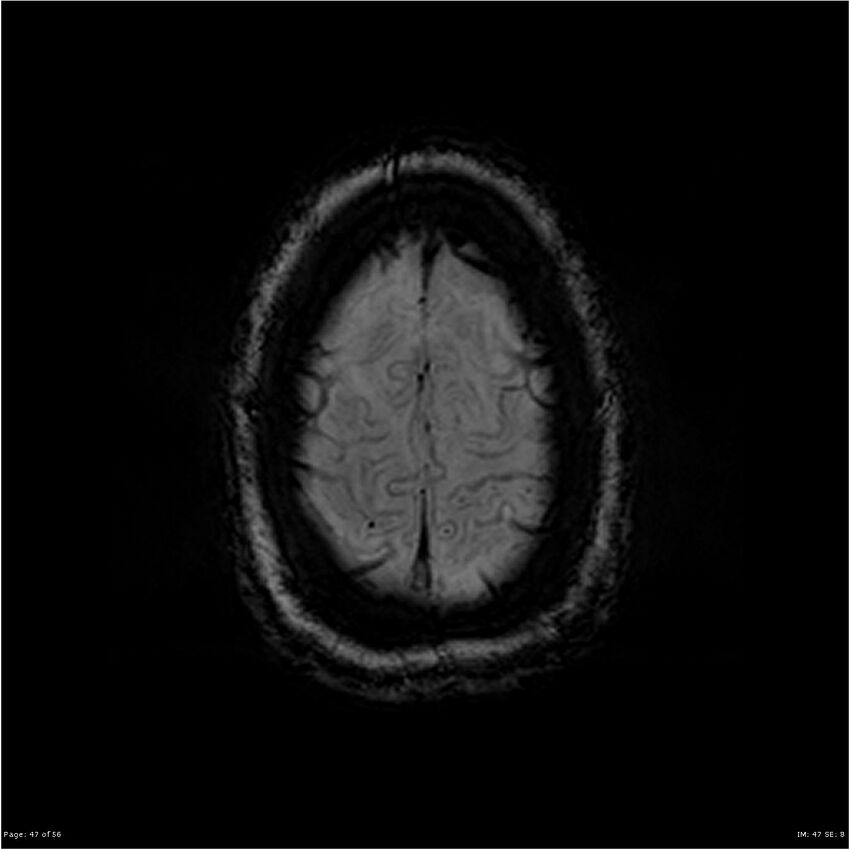 Chronic hypertensive encephalopathy (Radiopaedia 25764-25918 Axial SWI 47).jpg