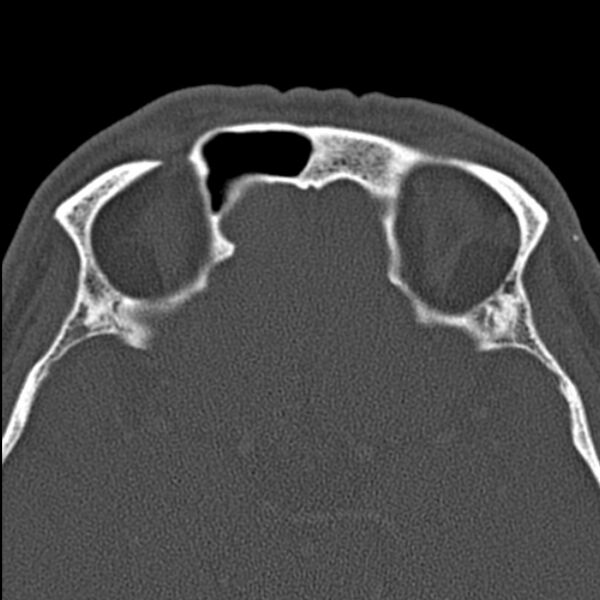 File:Chronic maxillary sinusitis (Radiopaedia 27879-28116 Axial bone window 44).jpg