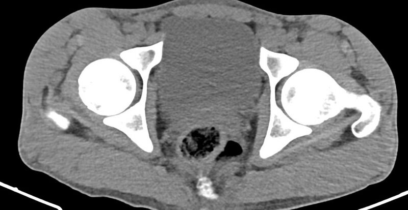 File:Chronic osteomyelitis (with sequestrum) (Radiopaedia 74813-85822 Axial 348).jpg