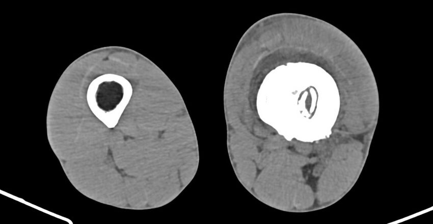 Chronic osteomyelitis (with sequestrum) (Radiopaedia 74813-85822 D 137).jpg