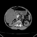 Chronic pancreatitis (Radiopaedia 23132-23172 Axial non-contrast 32).jpg
