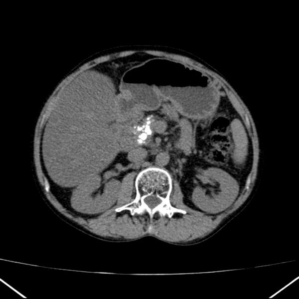 File:Chronic pancreatitis (Radiopaedia 23132-23172 Axial non-contrast 32).jpg