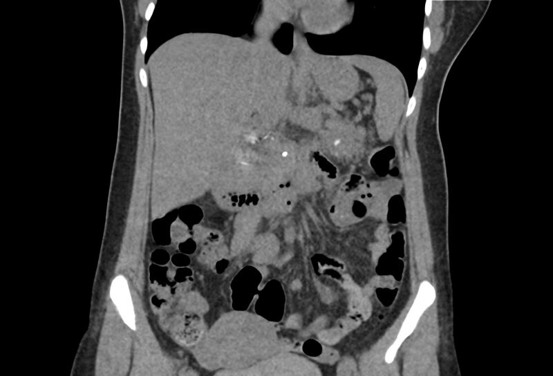 File:Chronic pancreatitis - pancreatic duct calculi (Radiopaedia 71818-82251 Coronal non-contrast 19).jpg