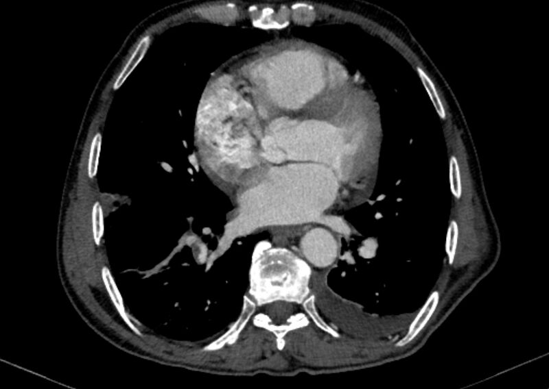 File:Chronic pulmonary embolism with bubbly consolidation (Radiopaedia 91248-108850 C+ arterial phase 94).jpg