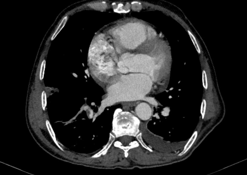 Chronic pulmonary embolism with bubbly consolidation (Radiopaedia 91248-108850 C+ arterial phase 94).jpg
