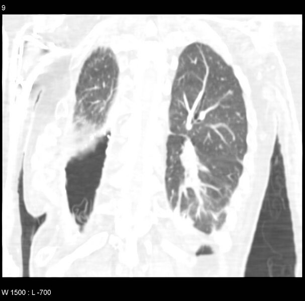 File:Clagett thoracotomy (Radiopaedia 8568-9403 Coronal lung window 9).jpg