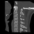 Clay-shoveler fracture (Radiopaedia 22568-22590 Sagittal bone window 21).jpg