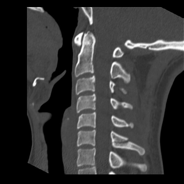 File:Clay-shoveler fracture (Radiopaedia 22568-22590 Sagittal bone window 21).jpg