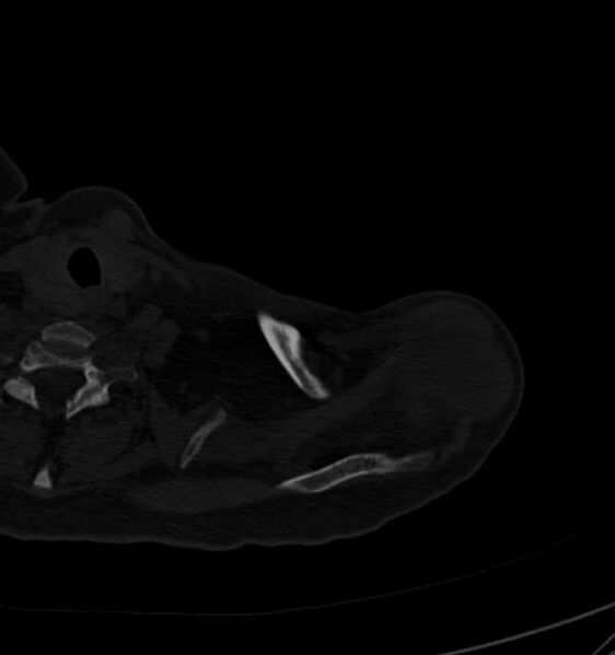 File:Clear cell chondrosarcoma - humerus (Radiopaedia 63104-71612 Axial bone window 14).jpg