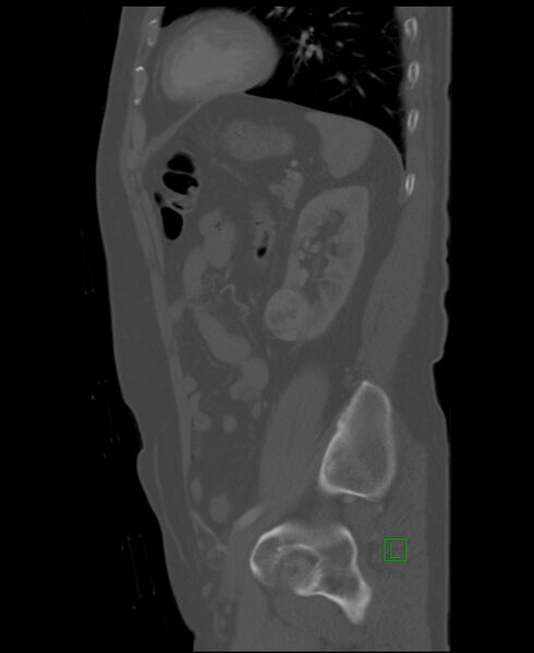 File:Clear cell renal cell carcinoma (Radiopaedia 85006-100539 Sagittal bone window 17).jpg