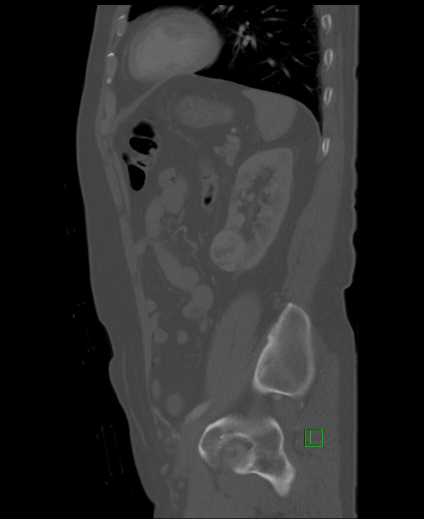 Clear cell renal cell carcinoma (Radiopaedia 85006-100539 Sagittal bone window 17).jpg