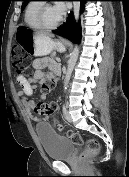 File:Closed loop obstruction - internal hernia into nephrectomy bed (Radiopaedia 59867-67320 C 40).jpg