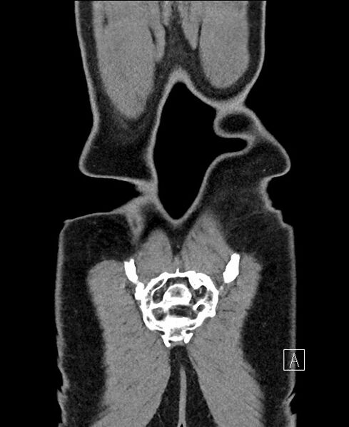 File:Closed loop small bowel obstruction - internal hernia (Radiopaedia 57806-64778 A 118).jpg