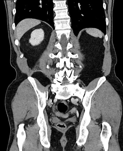 File:Closed loop small bowel obstruction - internal hernia (Radiopaedia 57806-64778 A 88).jpg