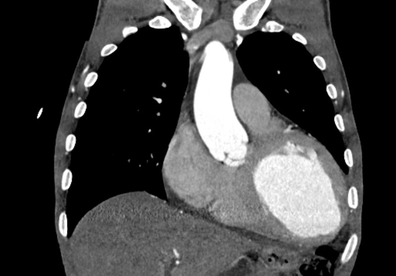 File:Coarctation of aorta with aortic valve stenosis (Radiopaedia 70463-80574 C 70).jpg