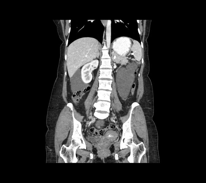 File:Cocoon abdomen with possible tubo-ovarian abscess (Radiopaedia 46235-50636 B 33).jpg