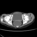 Colocolic fistula - Crohn disease (Radiopaedia 57063-63955 A 87).jpg
