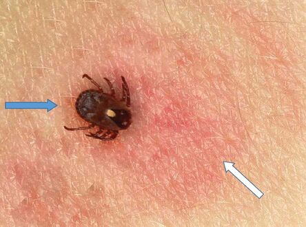 Lone star tick causing Southern tick-associated rash illness, and target erythematous lesion on right leg