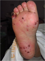 Multiple dark maculae on the sole of the right foot resembling septic emboli/Janeway lesions