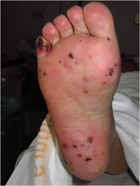 Janeway lesions foot2.png