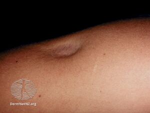 Lipoatrophy (DermNet NZ dermal-infiltrative-lipoatrophy).jpg
