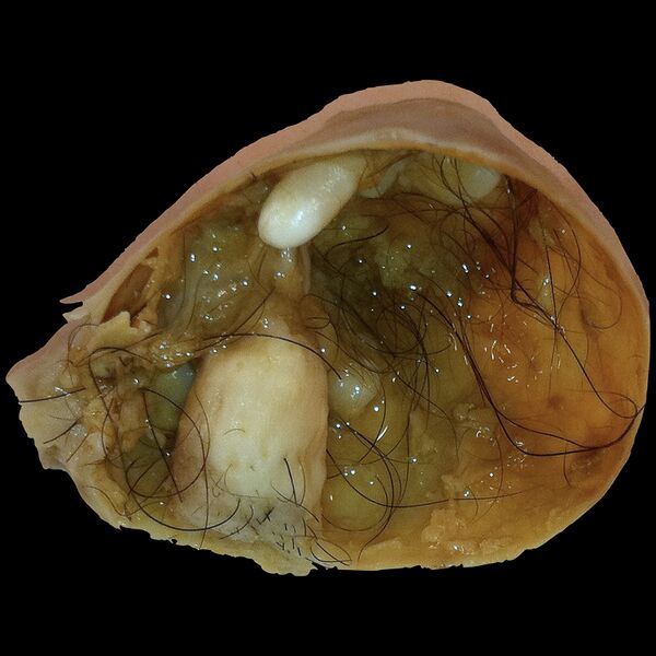 File:Mature cystic ovarian teratoma - gross pathology (Radiopaedia 77604).jpeg