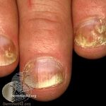 Nail psoriasis (DermNet NZ scaly-nail-psoriasis-3232).jpg
