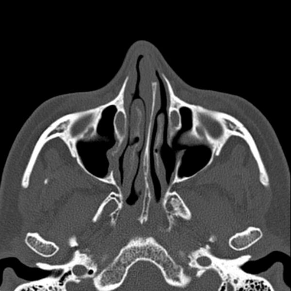 File:Nasal septal perforation (Radiopaedia 25030-25289 Axial bone window 22).jpg
