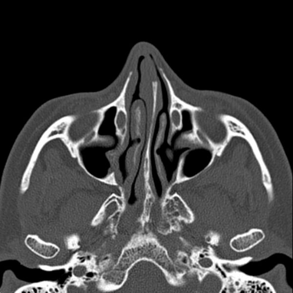 File:Nasal septal perforation (Radiopaedia 25030-25289 Axial bone window 23).jpg