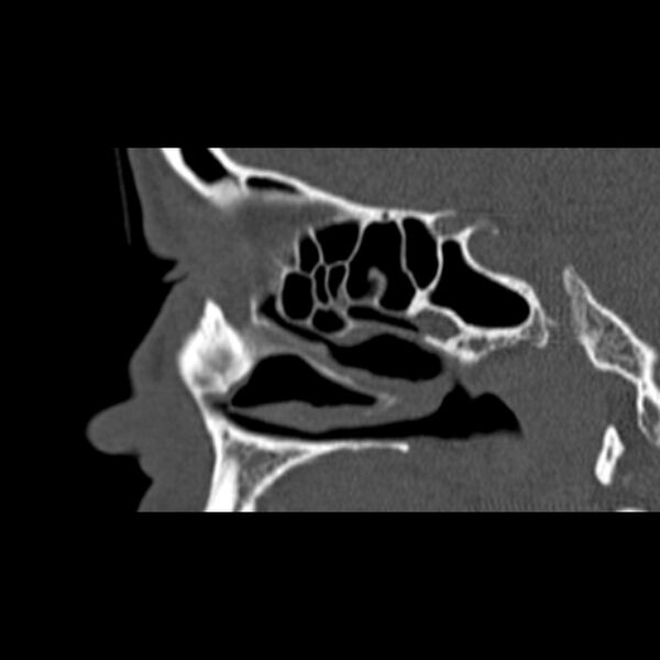 File:Nasal septal perforation (Radiopaedia 25030-25289 Sagittal bone window 44).jpg