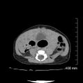 Neonatal neuroblastoma (Radiopaedia 56651-63438 Axial non-contrast 55).jpg