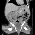 Neonatal neuroblastoma (Radiopaedia 56651-63438 Coronal non-contrast 28).jpg