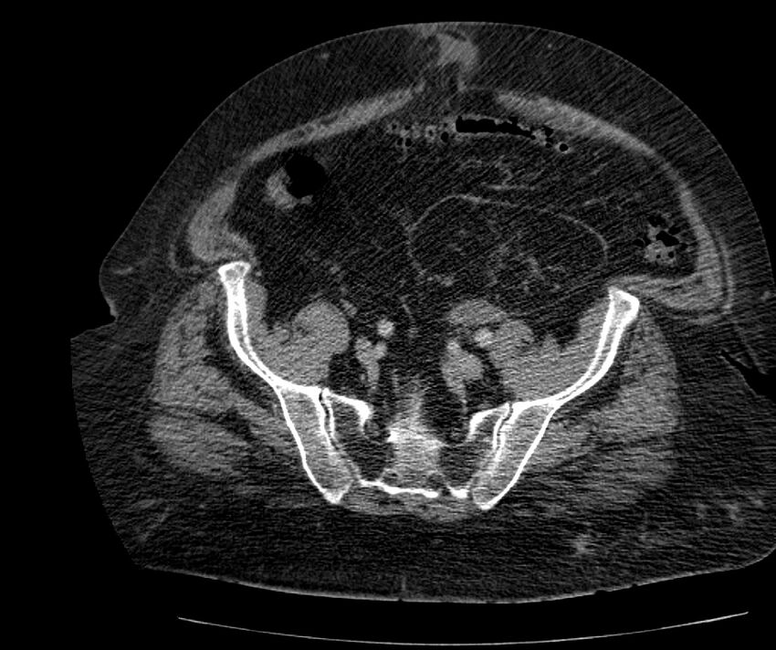 Nephroptosis with inguinal hernia containing perirenal fat (Radiopaedia 56632-63391 C 265).jpg
